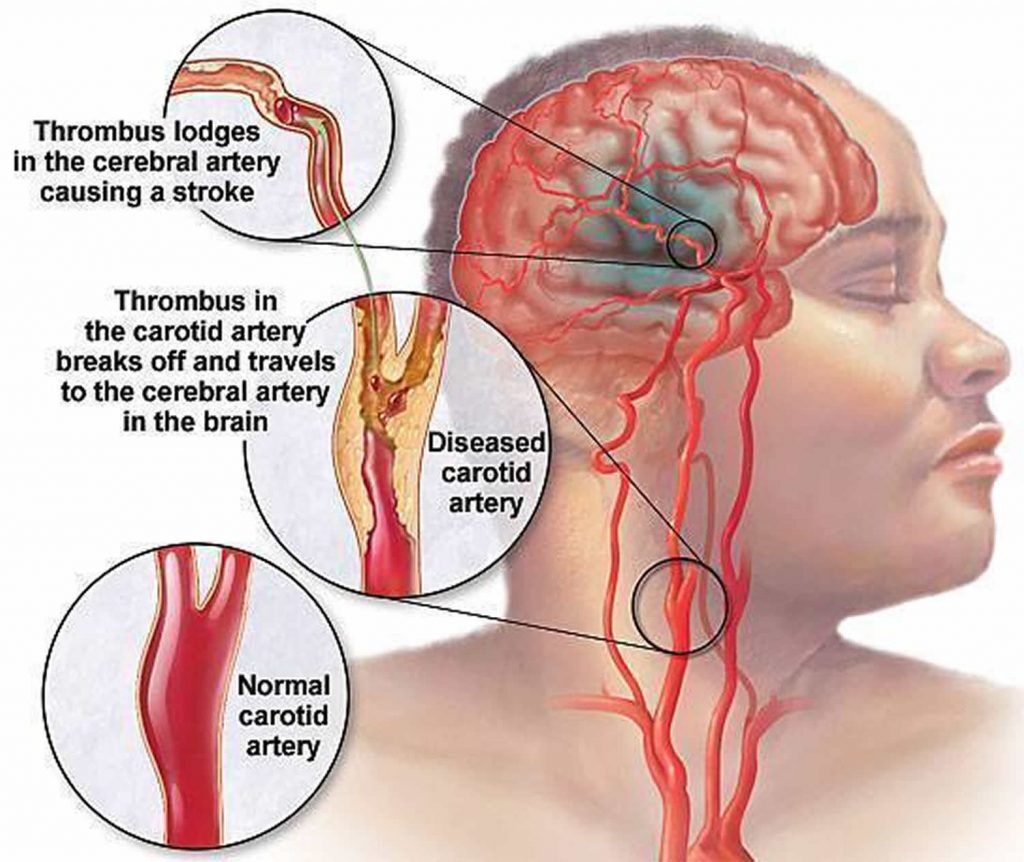 Ask the doctor: Is it worrisome to hear a pulse in my ear?